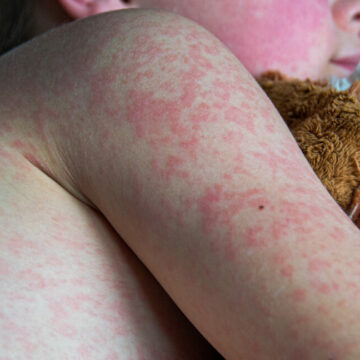 Le nombre de cas de rougeole atteint son plus haut niveau depuis 33 ans, alors que RFK Jr. poursuit son programme anti-vaccins