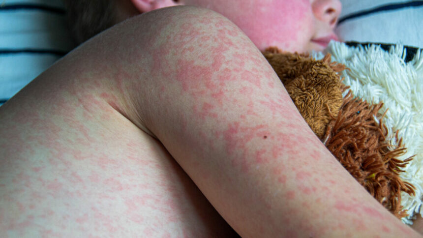 Le nombre de cas de rougeole atteint son plus haut niveau depuis 33 ans, alors que RFK Jr. poursuit son programme anti-vaccins