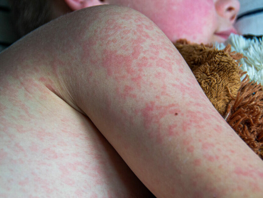 Le nombre de cas de rougeole atteint son plus haut niveau depuis 33 ans, alors que RFK Jr. poursuit son programme anti-vaccins